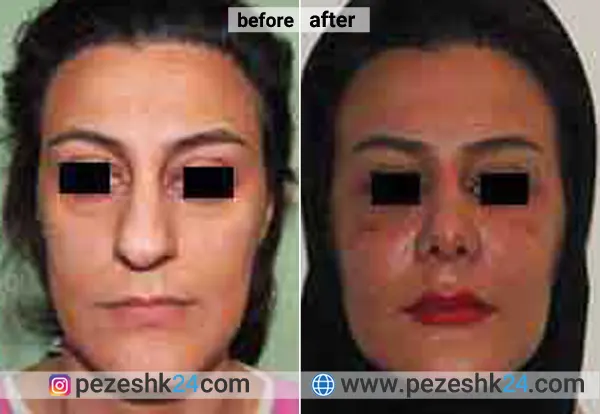 نمونه جراحی کاشت گونه دکتر نداف کرمانی 2
