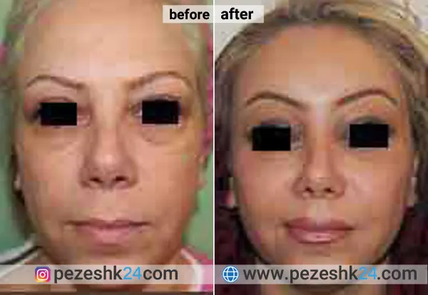 نمونه جراحی کاشت گونه دکتر نداف کرمانی 3