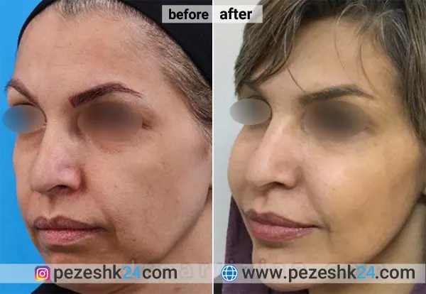 نمونه جراحی کاشت گونه دکتر پرویزیان 1