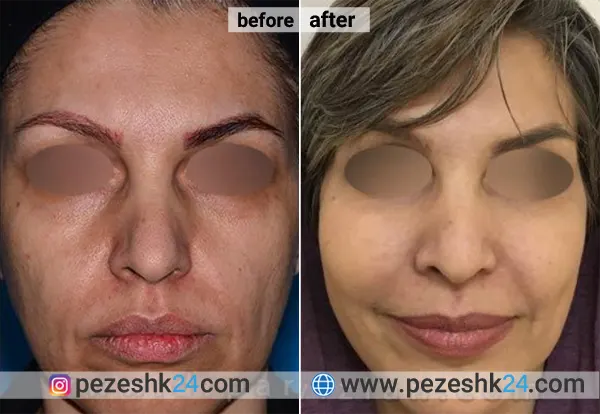 نمونه جراحی کاشت گونه دکتر پرویزیان 2