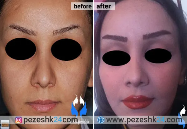 نمونه جراحی کاشت گونه دکتر صوفی زاده 1