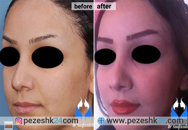 نمونه جراحی کاشت گونه دکتر صوفی زاده 2