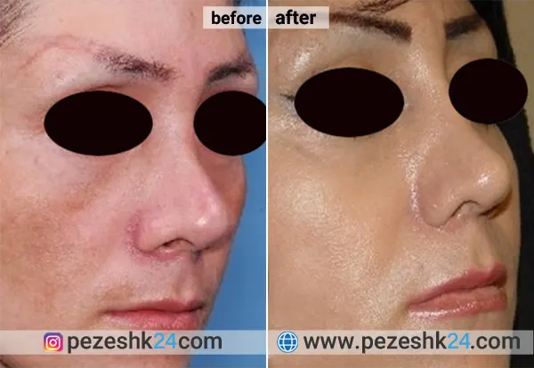 نمونه جراحی کاشت گونه دکتر صوفی زاده 3