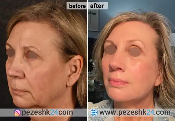 قبل و بعد جراحی لیفت لب اصفهان