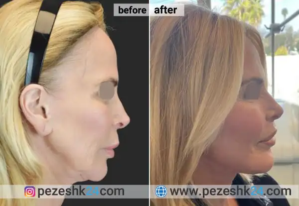 قبل و بعد لیفت لب در اصفهان