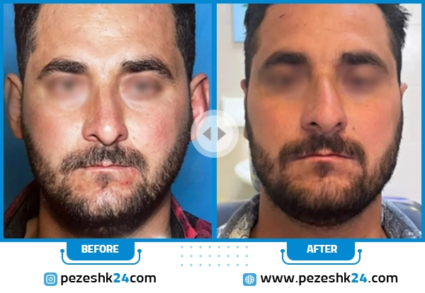قبل و بعد جراحی اتوپلاستی گوش دکتر شکوهی