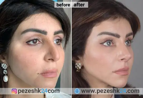 قبل و بعد جراحی لیفت شقیقه اصفهان