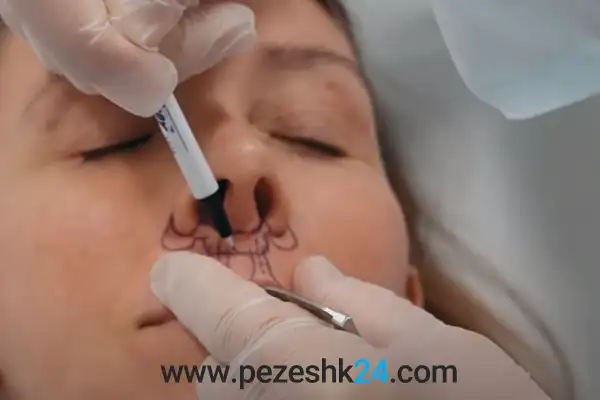 لیفت لب شاخ گاوی در اصفهان