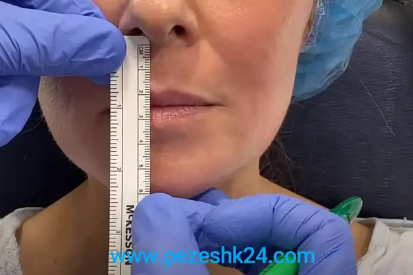 لیفت لب مستقیم در اصفهان