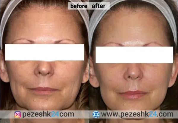 نمونه جراحی لیفت صورت دکتر عین آبادی