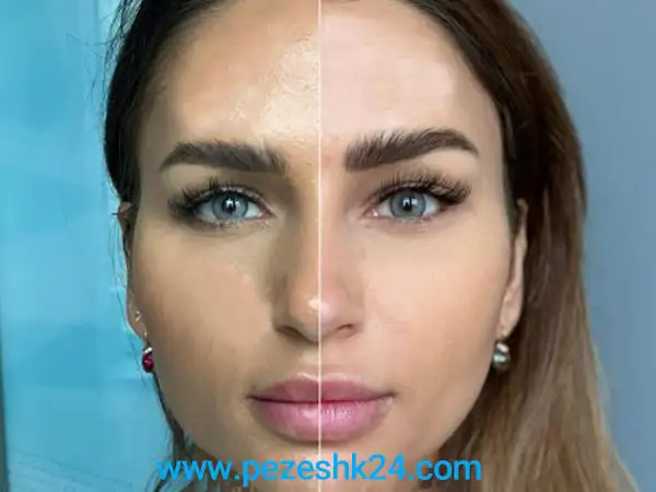 نمونه عکس جراحی لیفت شقیقه در اصفهان