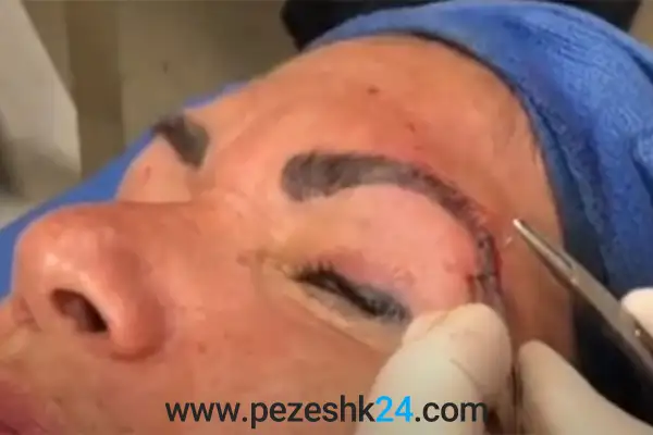 جراحی لیفت شقیقه اصفهان