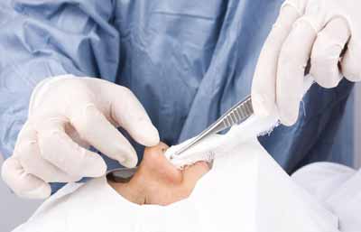 جراحی بینی بدون تامپون اصفهان