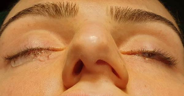 عدم تقارن سوراخ های بینی