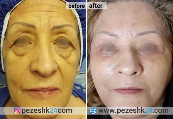 نمونه جراحی لیفت صورت دکتر مقدم نیا