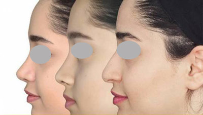 جراحی بینی با کمک قالب کنترلی