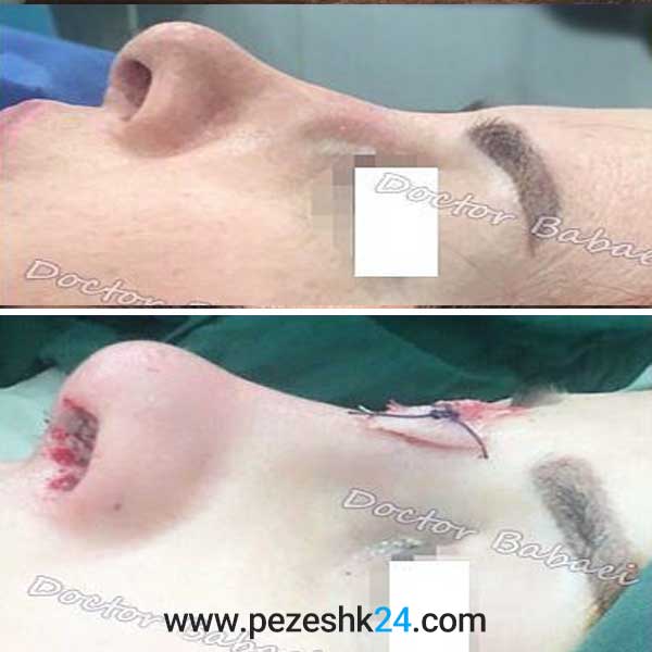نمونه جراحی ترمیم بینی دکتر بابایی