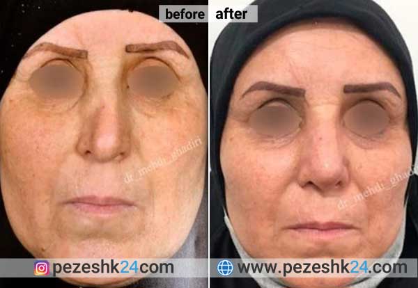 نمونه جراحی ترمیم بینی دکتر قدیری 1