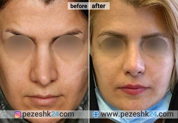 نمونه جراحی ترمیم بینی دکتر خورده چی 1