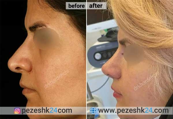 نمونه جراحی ترمیم بینی دکتر خورده چی 2