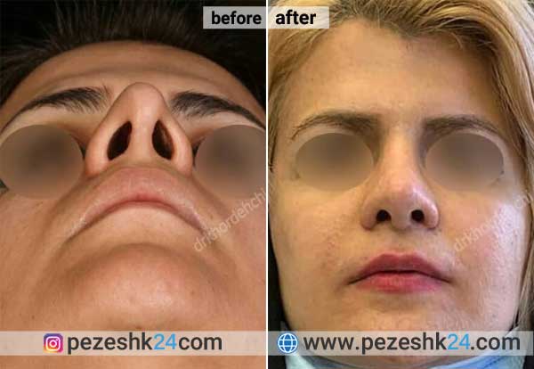 نمونه جراحی ترمیم بینی دکتر خورده چی 3