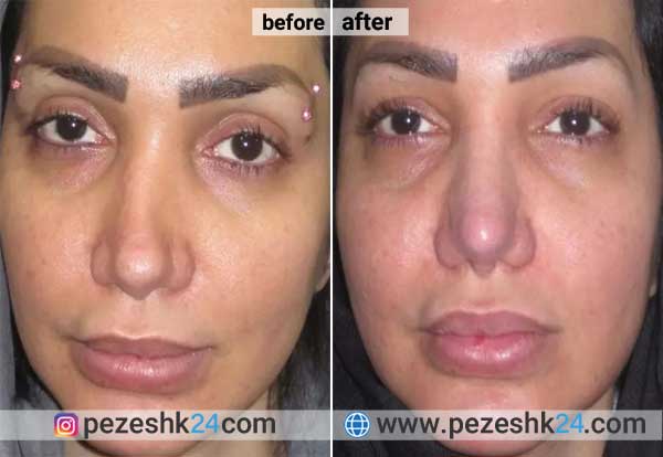 نمونه جراحی ترمیم بینی دکتر معمارزاده 2