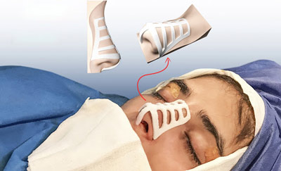 هزینه عمل بینی با قالب کنترلی