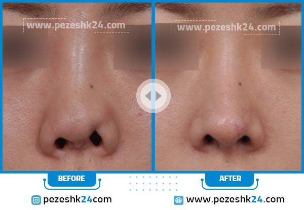 عدم تقارن سوراخهای بینی