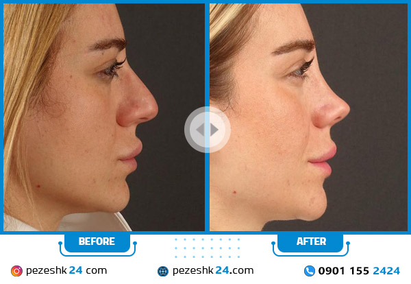 عوارض عمل بینی فانتزی