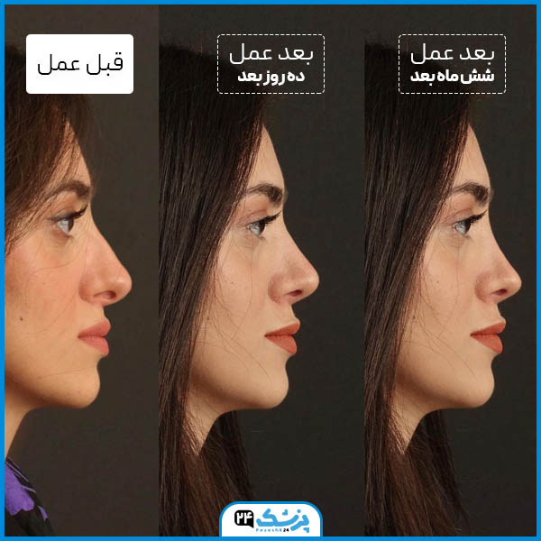 ورم عمل بینی