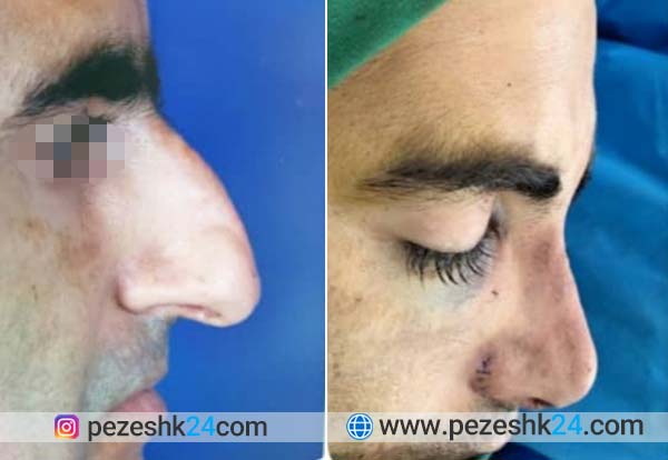 عکس قبل و بعد عمل بینی دکتر احمدی شیراز