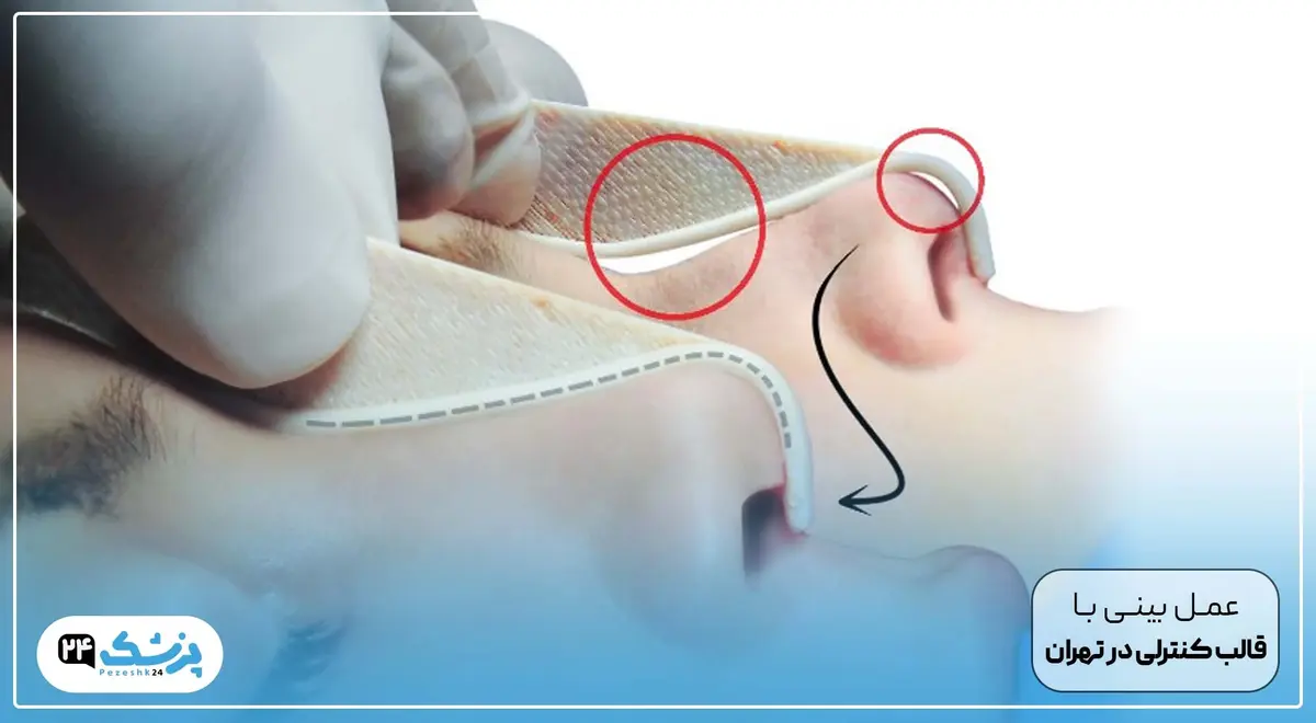 عمل بینی با قالب کنترلی در تهران