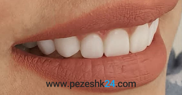 قبل و بعد لمینت دندان دکتر ثاقب تقی پور مشهد