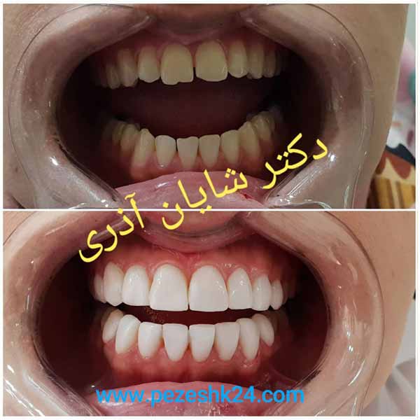 قبل و بعد لمینت دندان توسط دکتر آذری