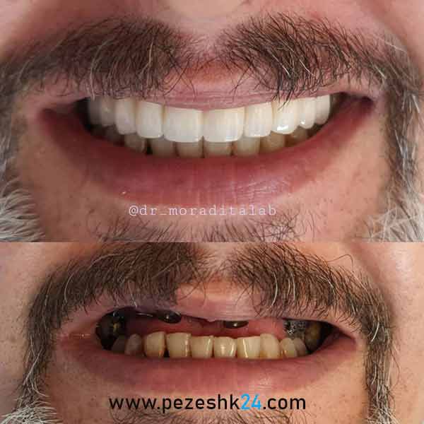 عکس قبل و بعد ایمپلنت دندان توسط دکتر عزیز مرادی طلب در مشهد 2