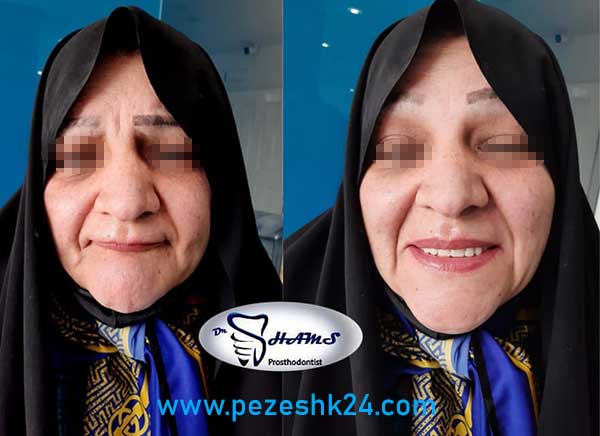 عکس قبل و بعد ایمپلنت دندان توسط دکتر حمید شمس در مشهد