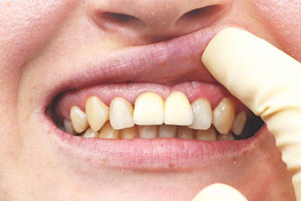 عوارض ایمپلنت ارزان در مشهد