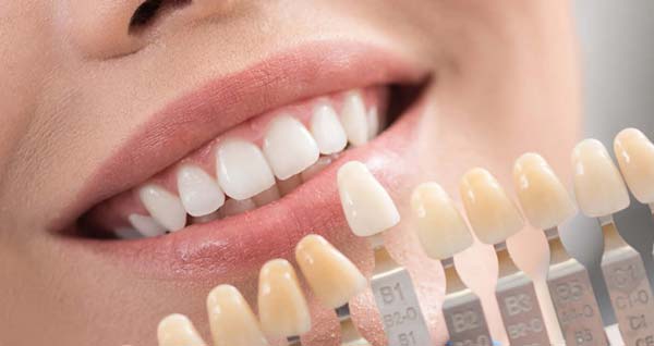 عوامل موثر بر قیمت لمینت دندان