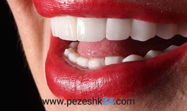 لمینت دندان دکتر فقیهینیا مشهد