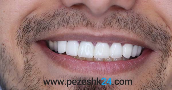 لمینت دندان توسط دکتر رخ فروز مشهد