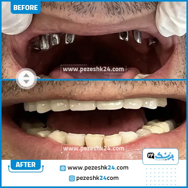 قبل و بعد ایمپلنت دندان دکتر عباچی زاده