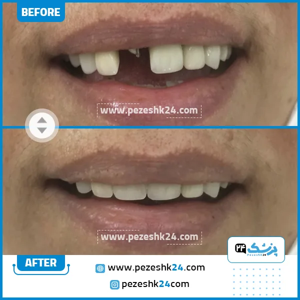 قبل و بعد ایمپلنت دکتر عباچی زاده