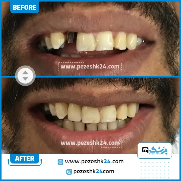 قبل و بعد ایمپلنت دندان دکتر عباچی زاده مشهد
