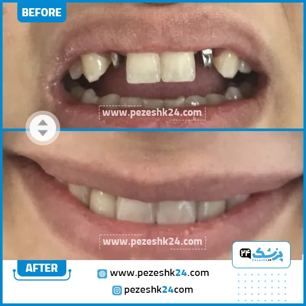 قبل و بعد ایمپلنت دکتر عباچی زاده مشهد