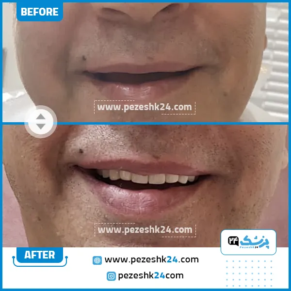 قبل و بعد ایمپلنت دندان دکتر رمضانی مشهد