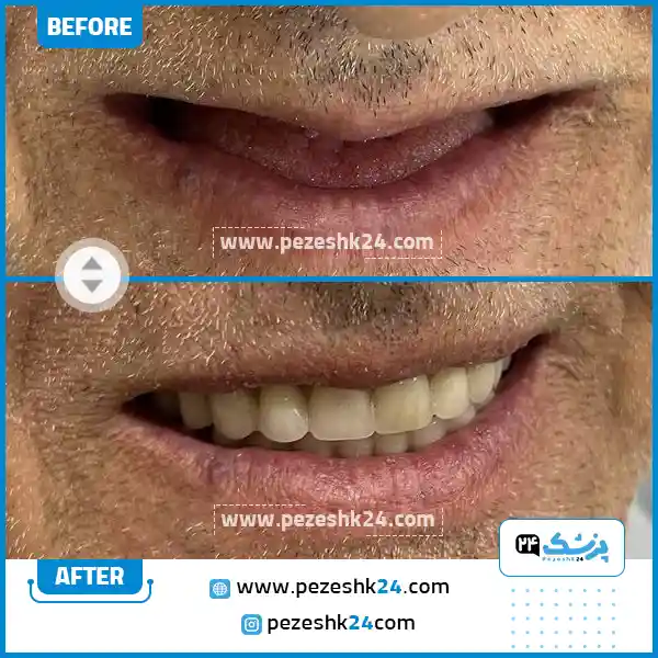 قبل و بعد ایمپلنت دکتر رمضانی