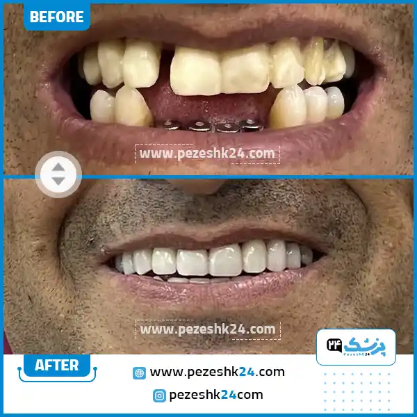 قبل و بعد ایمپلنت دندان دکتر رمضانی در مشهد
