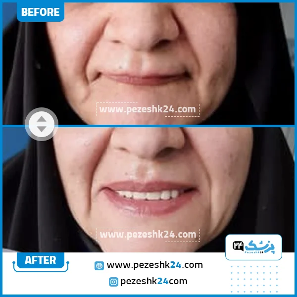 قبل و بعد ایمپلنت دندان دکتر شمس مشهد