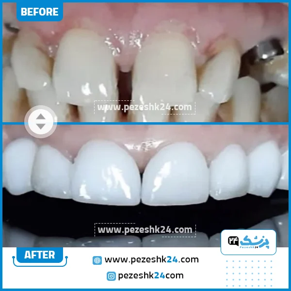 قبل و بعد ایمپلنت دندان دکتر شمس