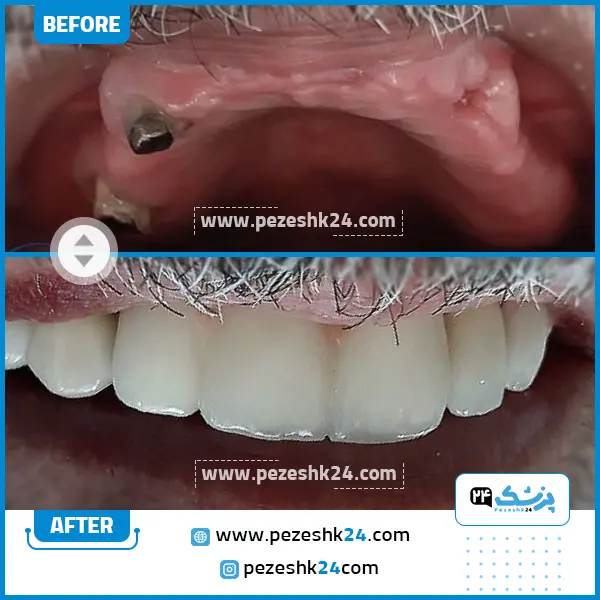 قبل و بعد ایمپلنت دکتر شمس مشهد